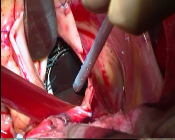 cardiac surgery gulab devi hospital lahore 1