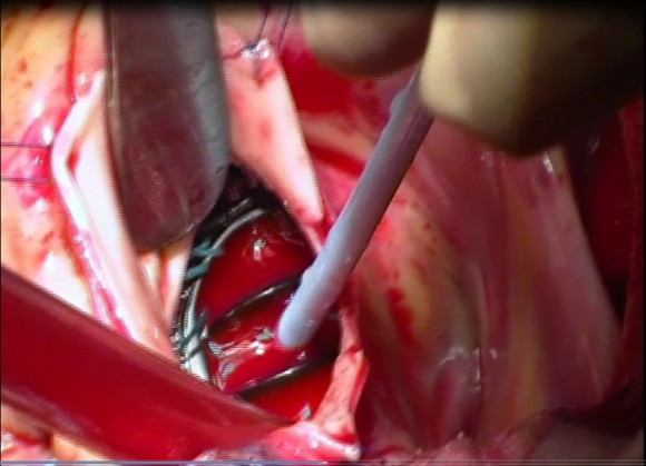 cardiac surgery gulab devi hospital lahore