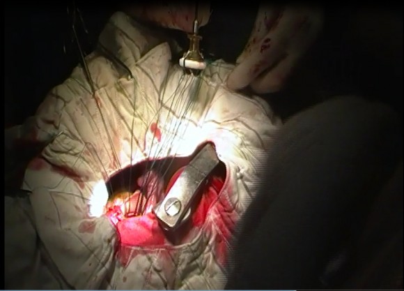 cardiac surgery valve replacement in gulab devi hospital